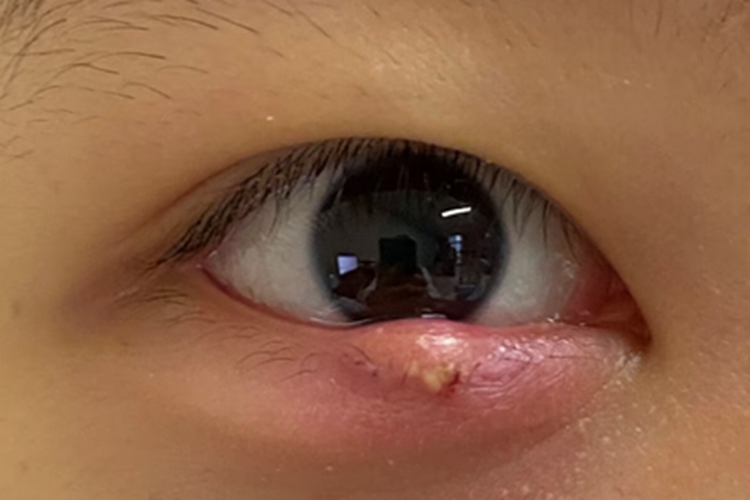 睑板腺炎眼睑小疙瘩图