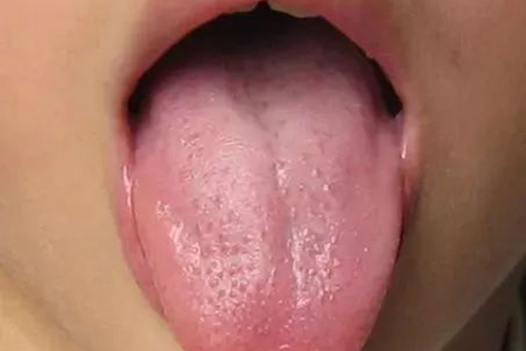 特禀体质舌苔图