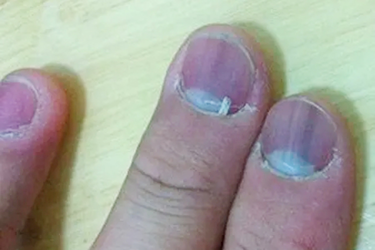 肺癌指甲变黑图