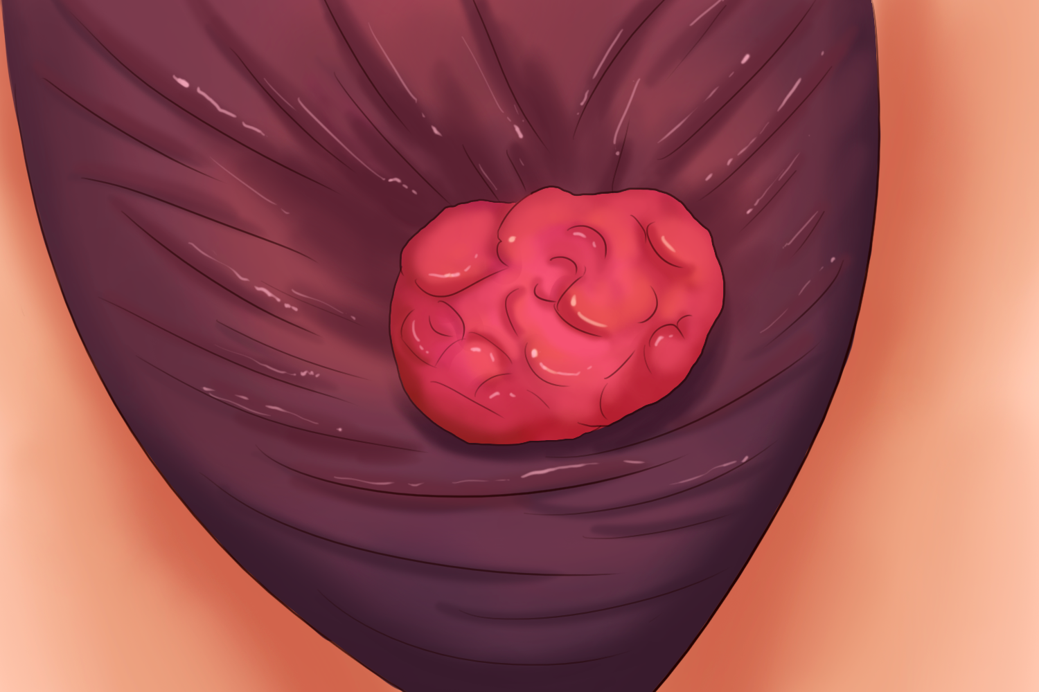 阴囊疣状黄瘤 阴囊疣状黄瘤