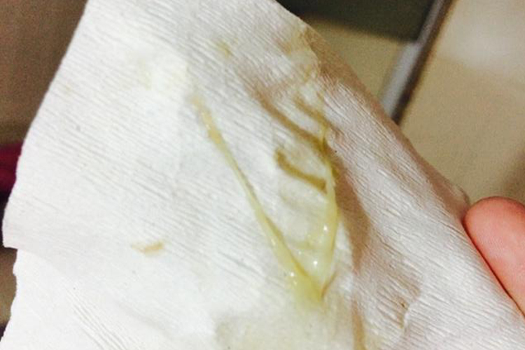 滴虫性阴道炎黄色分泌物图 滴虫性阴道炎黄色分泌物图