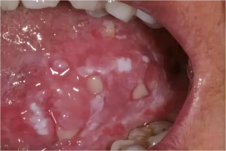 口腔念珠菌病颗粒增生图 口腔念珠菌病颗粒增生图