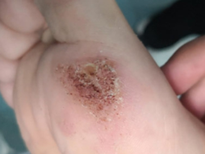 寻常疣脚底一片黑褐色血点图.jpg