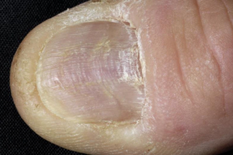 扁平苔藓脚趾甲增厚图