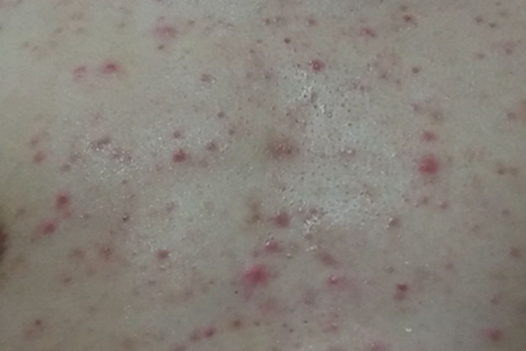 细菌性毛囊炎胸部小红疙瘩图