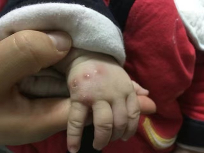 新生儿脓疱疮症状图片