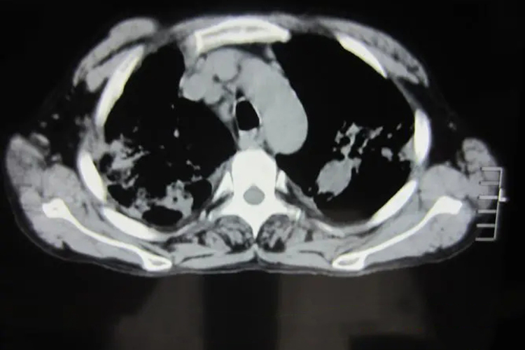 胸壁结核脓肿影像图 胸壁结核脓肿影像图