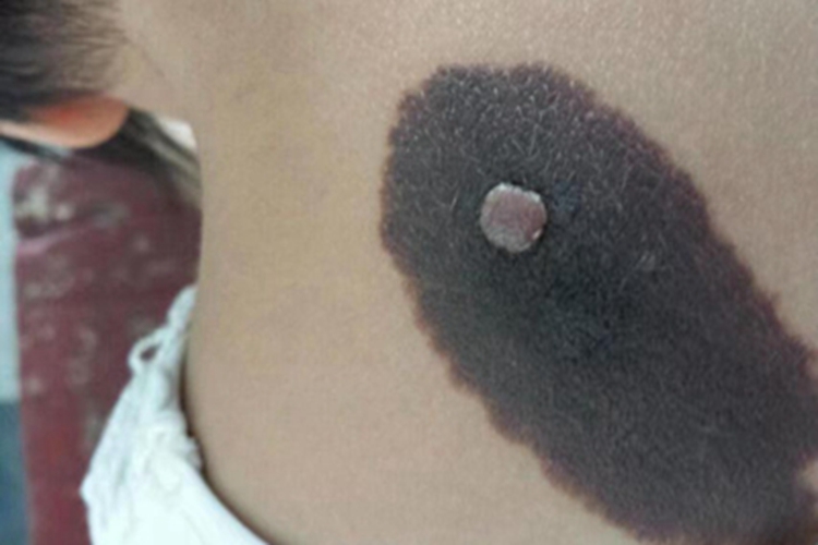 复合痣背部黑斑图 复合痣背部黑斑图