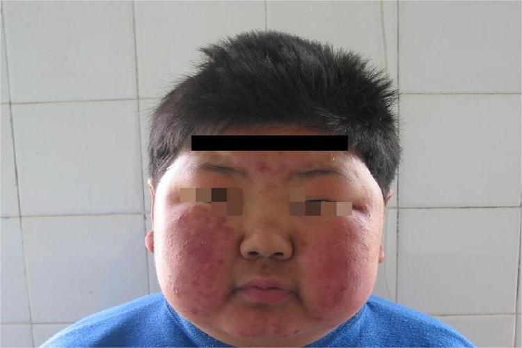 库欣综合征红斑图