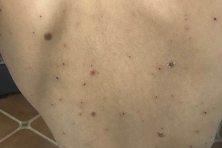 水痘背部结痂图