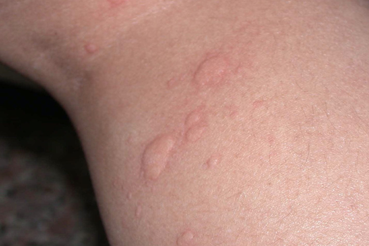 刺毛虫皮炎荨麻疹样皮疹图