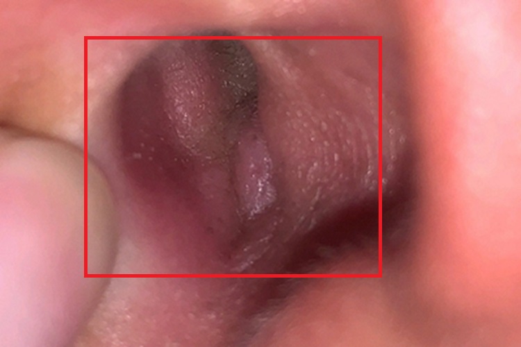 外耳道炎外耳道充血图 外耳道炎外耳道充血图