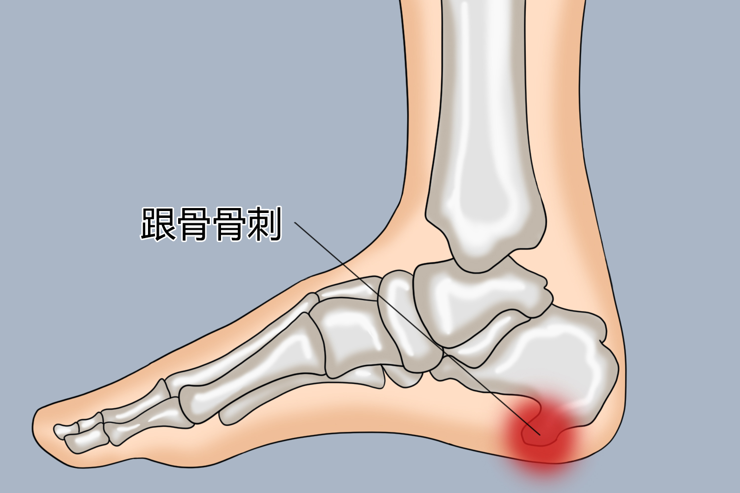 足跟骨刺位置图