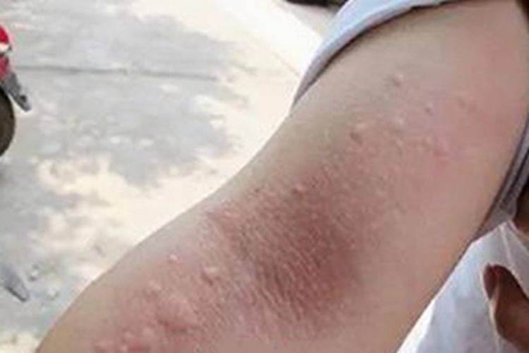 松毛虫皮炎疙瘩图 松毛虫皮炎疙瘩图