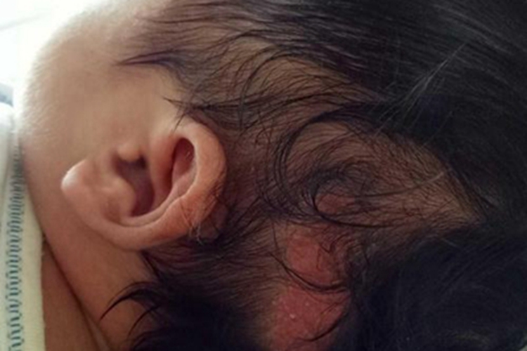 新生儿皮脂腺增生头皮症状图 新生儿皮脂腺增生头皮症状图
