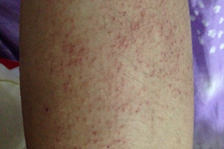 色素性紫癜性皮疹小腿红点图