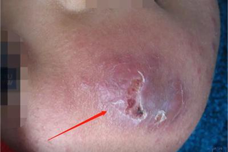 冻疮样红斑狼疮皮肤发红图