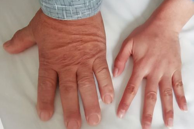 肢端肥大症图（左）