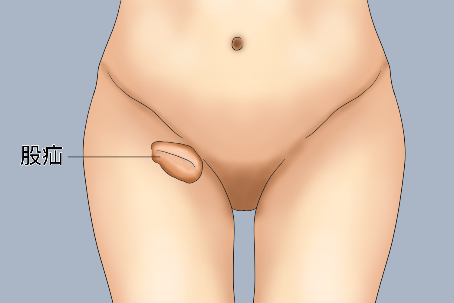 女性股疝图 女性股疝图