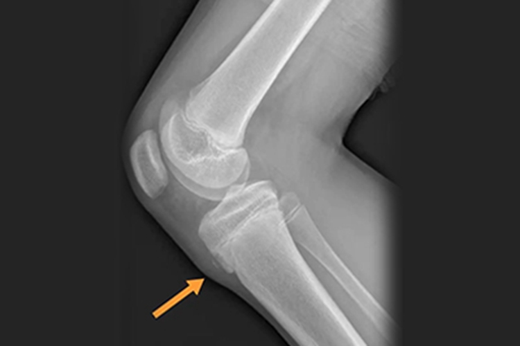 胫骨结节炎X线图 胫骨结节炎X线图