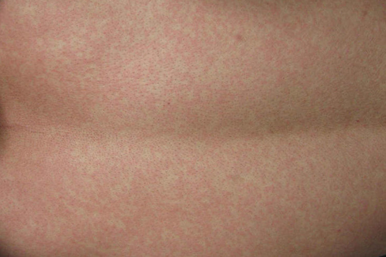 麻疹型药疹小米粒疙瘩图