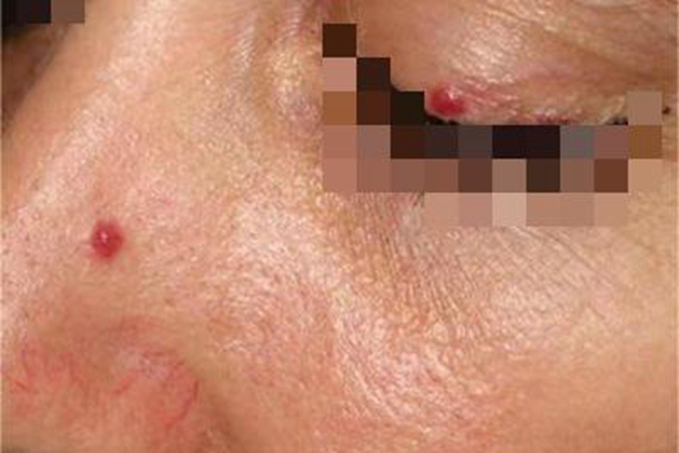 樱桃状血管瘤面部小红疙瘩图 樱桃状血管瘤面部小红疙瘩图