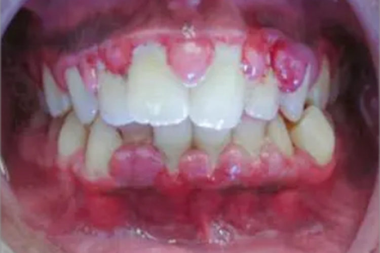 妊娠期龈炎症状图