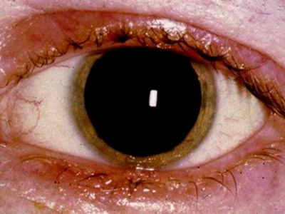 急性苯中毒瞳孔异常变大图