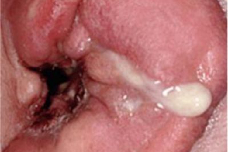 恶性外耳炎耳部化脓图