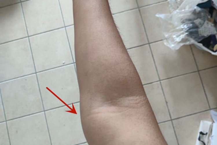 肘外翻手臂变形向外拐图 肘外翻手臂变形向外拐图