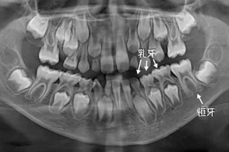儿童牙齿X光图