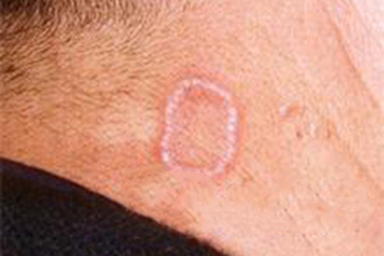 环状肉芽肿后颈症状图