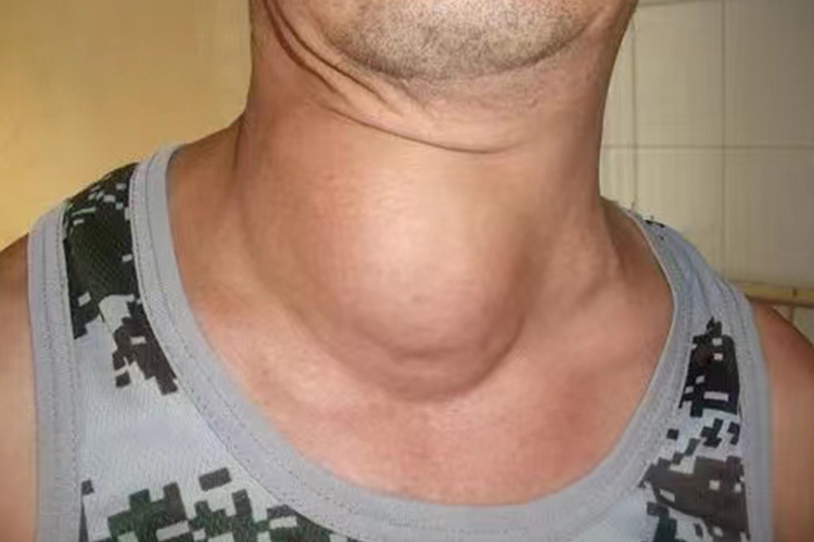 单纯性甲状腺肿患者甲状腺肿大图
