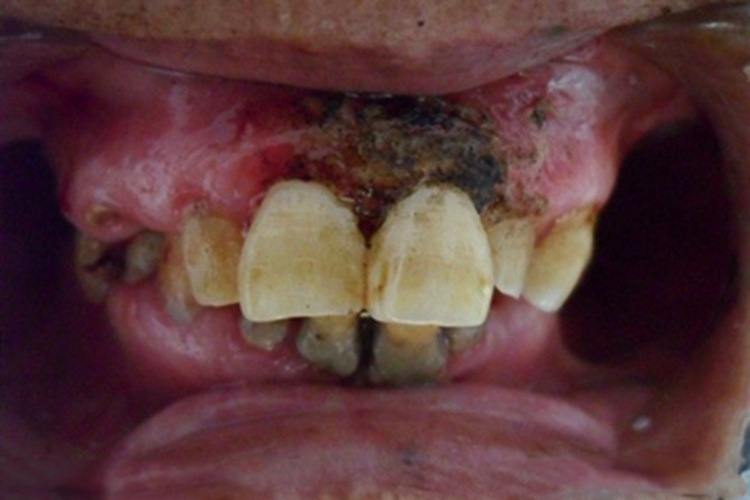 坏死性溃疡性龈口炎牙龈溃疡图