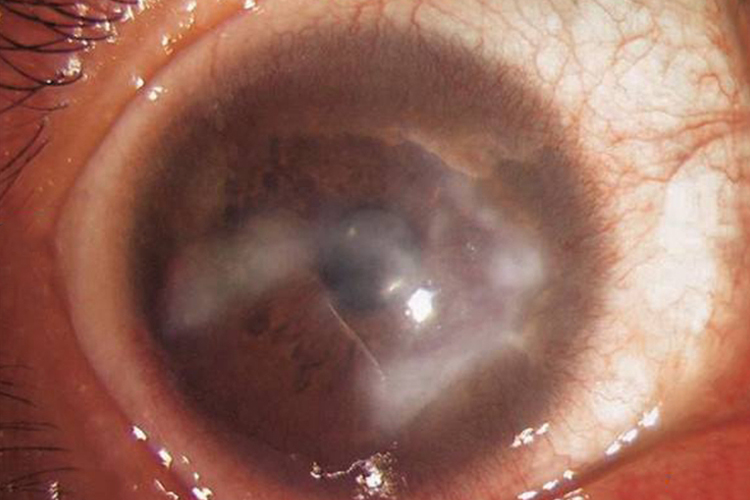 原发脂质角膜病变眼球脂肪沉积图 原发脂质角膜病变眼球脂肪沉积图