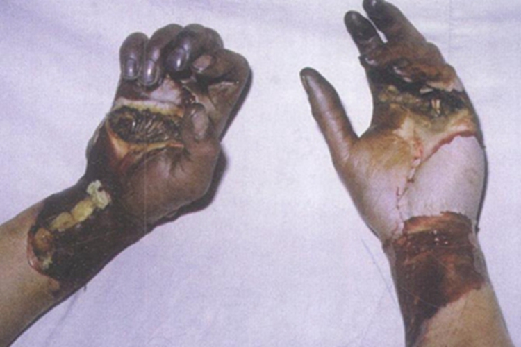 电弧烧伤手部黑痂图 电弧烧伤手部黑痂图