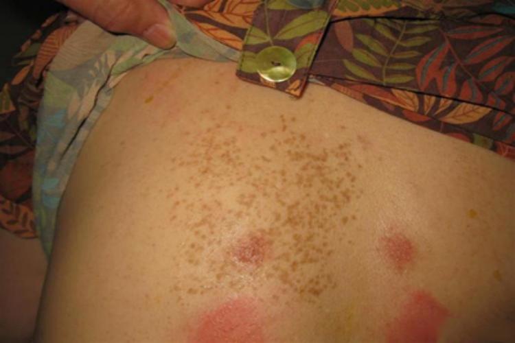 雀斑样痣肋部斑图 雀斑样痣肋部斑图