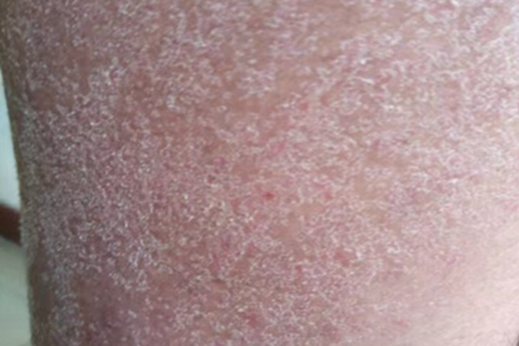 冬季瘙痒症脱屑图