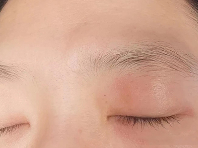 接触性睑皮炎眼睑发红肿胀图