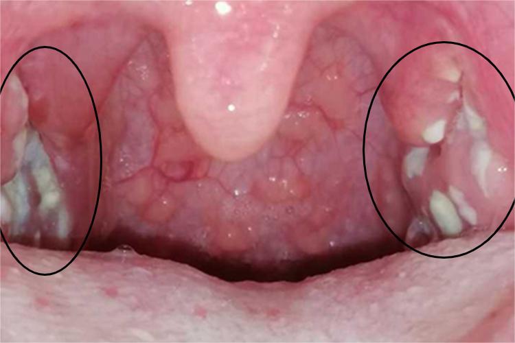 急性隐窝性扁桃体炎扁桃体症状图片