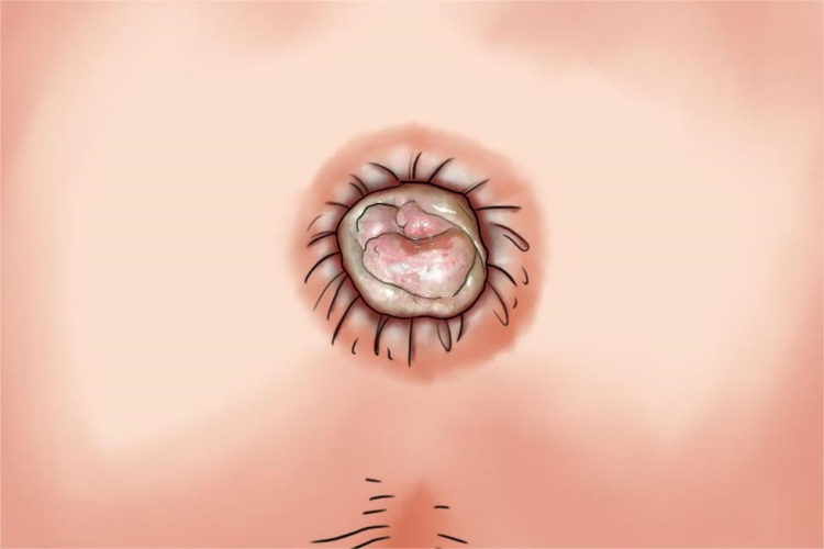 Ⅳ度内痔疙瘩手绘图 Ⅳ度内痔疙瘩手绘图