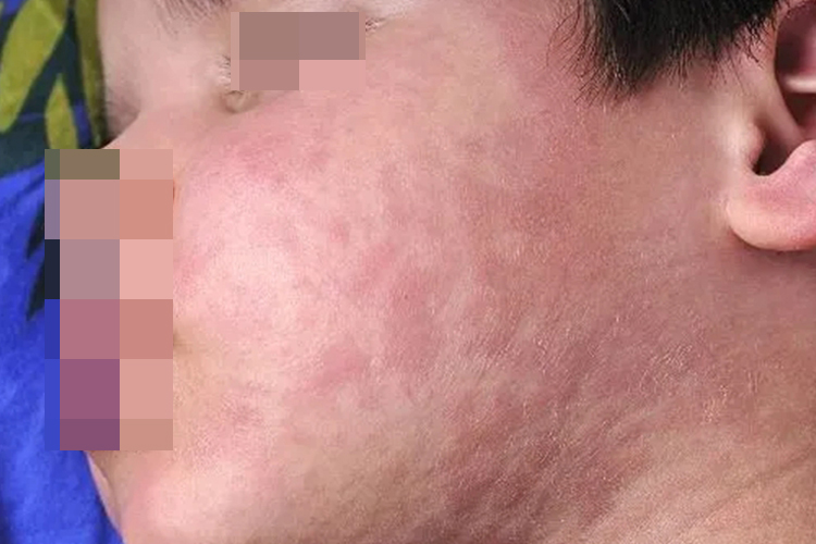 荨麻疹儿童脸上长风团图