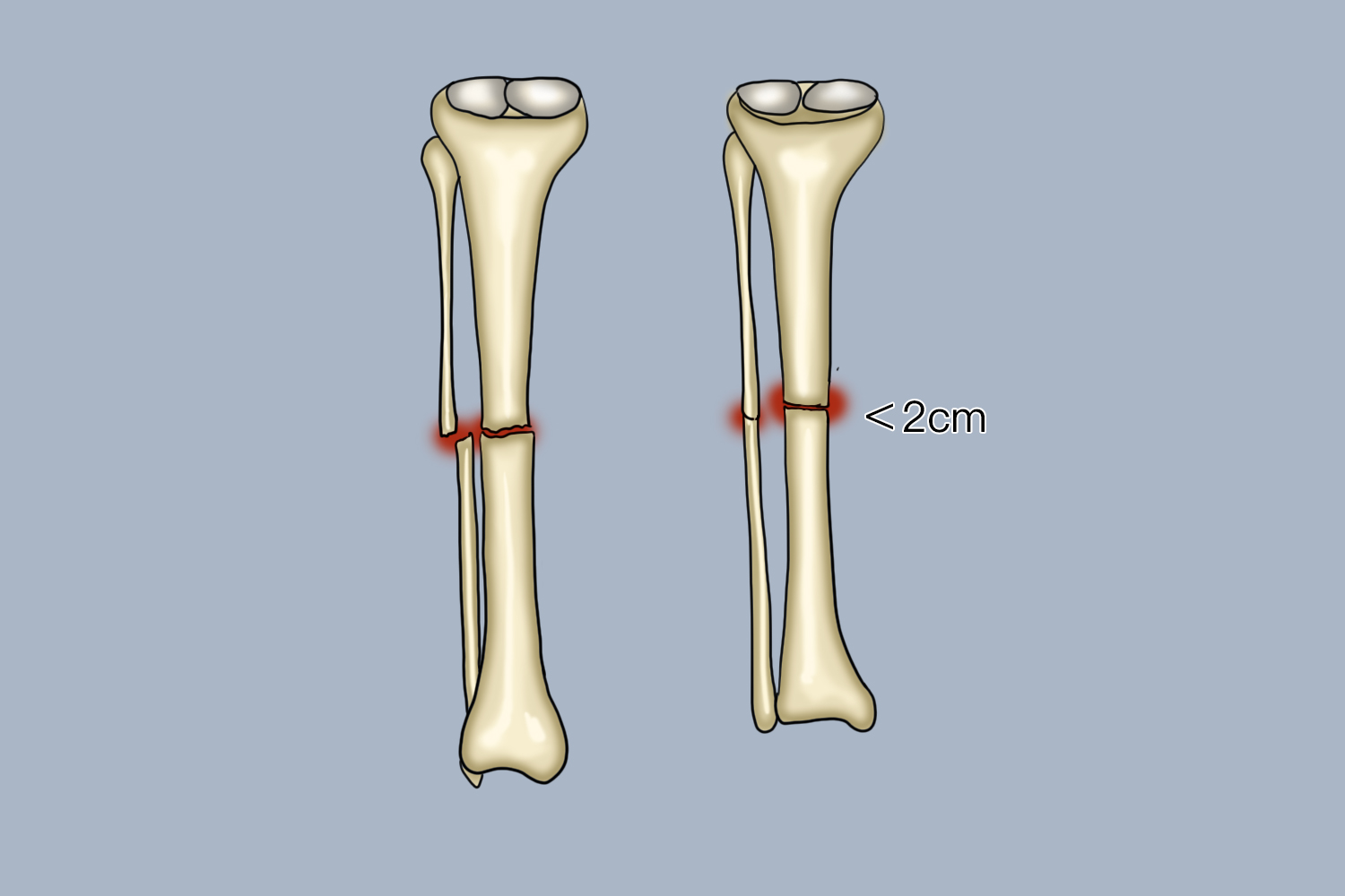 儿童骨折长度标准图