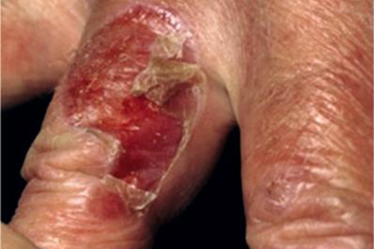 大疱性表皮松解症手指脱皮图