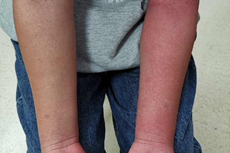 弥漫型类丹毒胳膊症状图