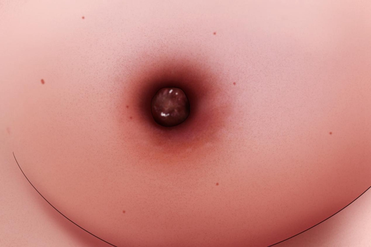 乳房酒窝征图 乳房酒窝征图