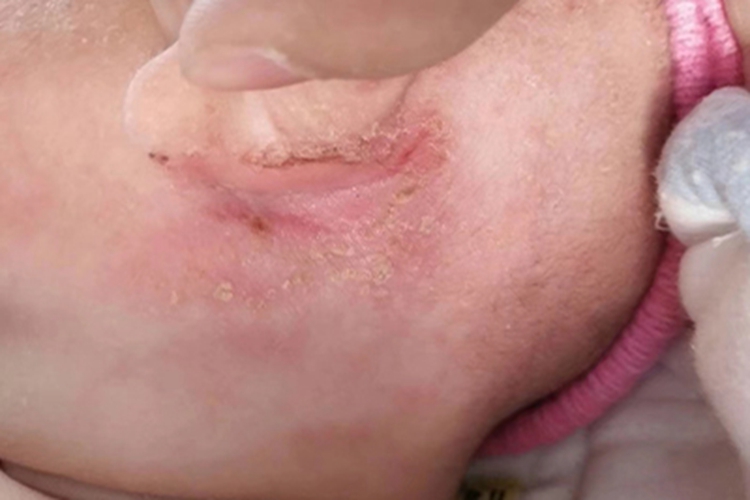 渗出型婴儿湿疹耳后糜烂图