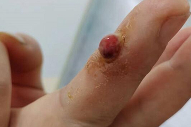 化脓性肉芽肿大红疙瘩图 化脓性肉芽肿大红疙瘩图