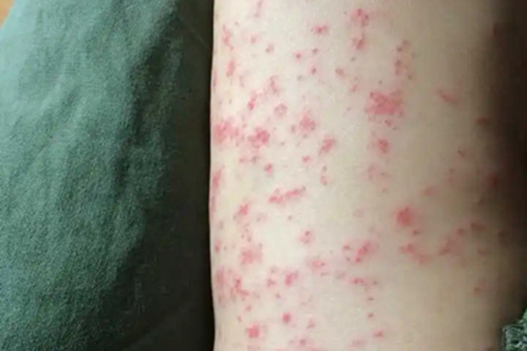 高IgD综合征大腿丘疹图