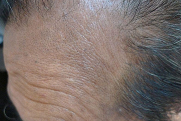 瑞尔黑变病皮肤发黑图